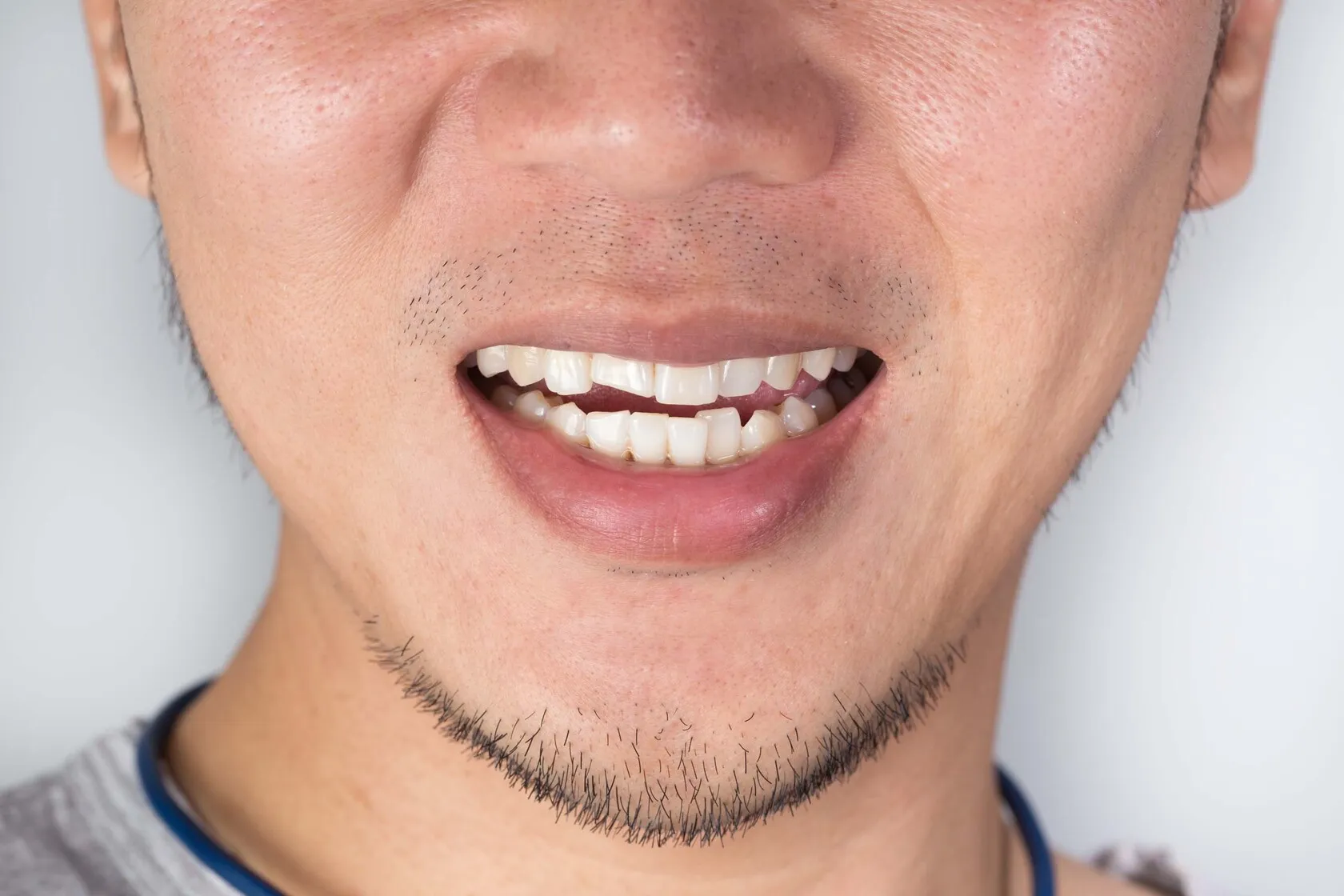 Chipped Tooth Repair