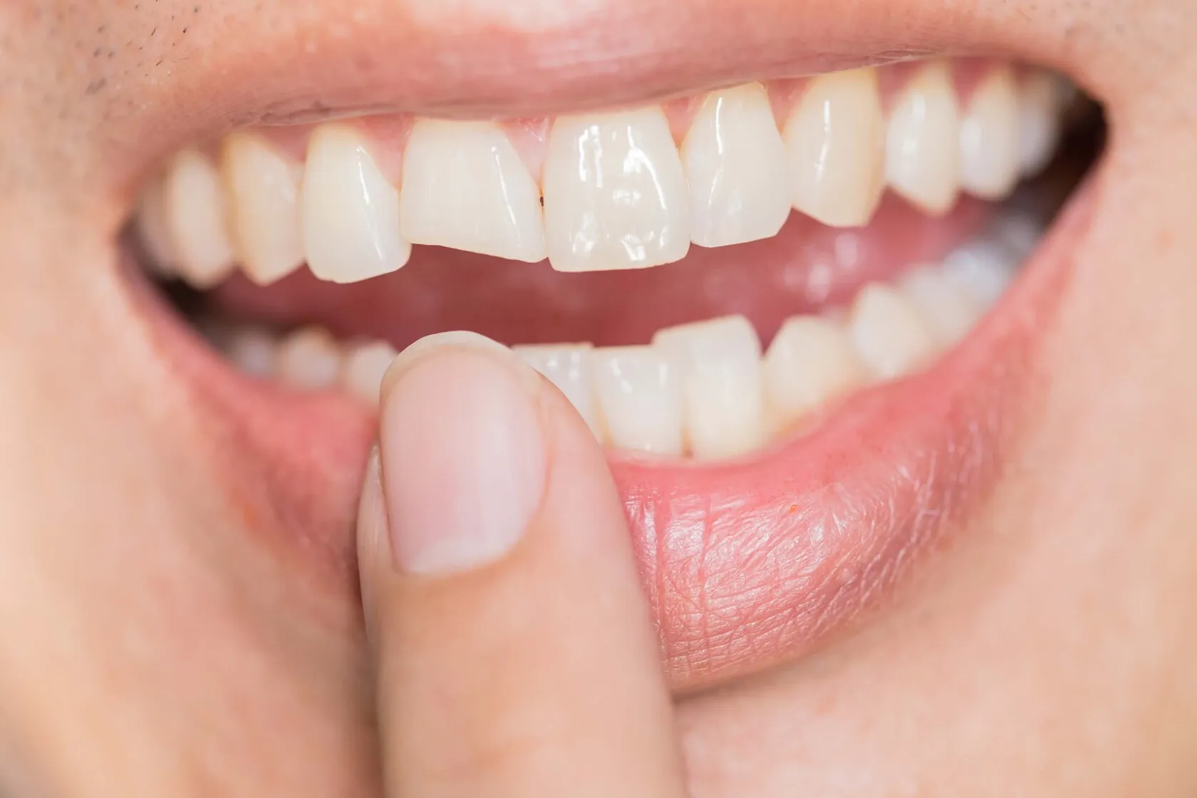 Cracked Tooth Repair