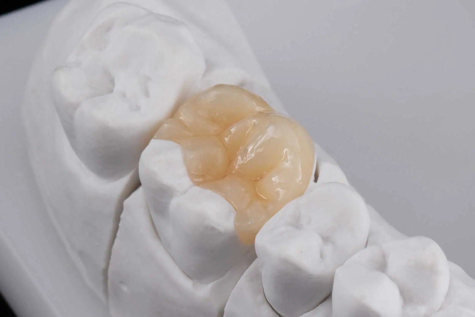 Dental Onlays